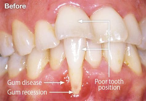 Gum Recession Non Surgical Treatments