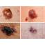 Melanoma Cancer Stats On The Rise In Older Adults