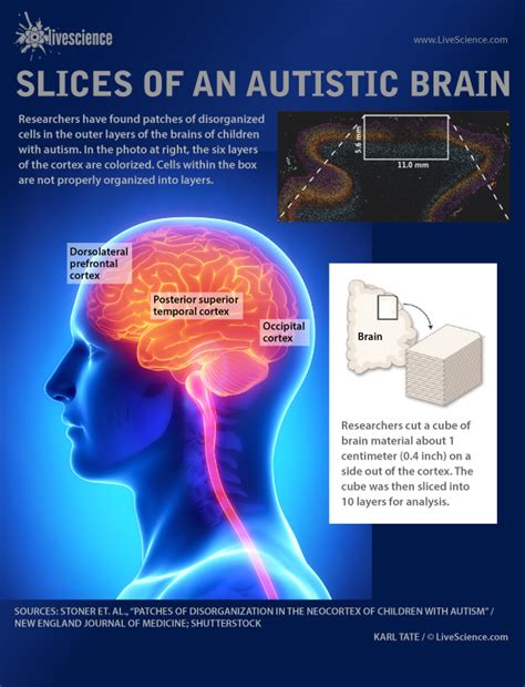 New Research Finds Cell Damage In Autistic Brain Infographic Live