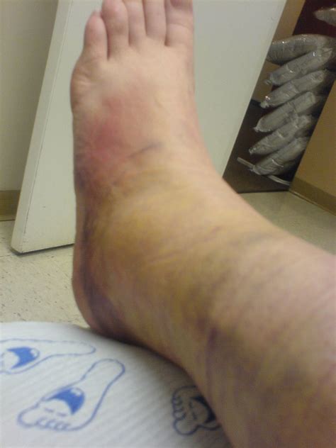 10 Days Sprained Ankle Crazy Bruising And Swelling From Flickr