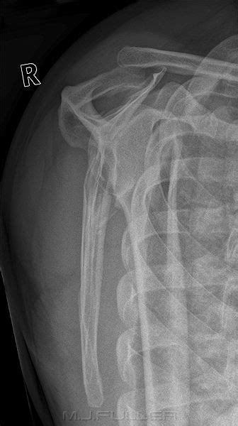 Glenoid Fracture Radiology Technologist Radiology Scapula