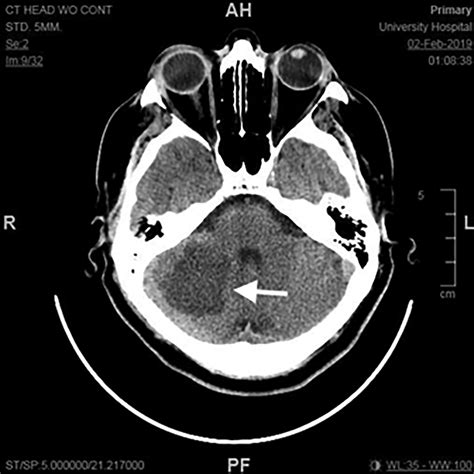 Cerebellar Stroke Mri