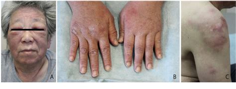 Figure 1 From Primary Cutaneous Gamma Delta T Cell Lymphoma Initially