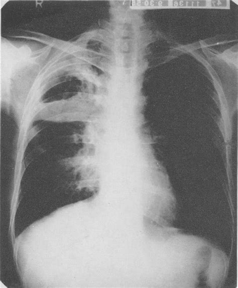 Pulmonary Aspergillosis With Cavitation — Iodide Therapy Associated