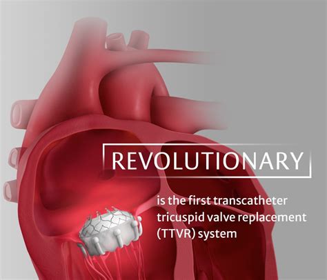 Evoque Tricuspid Valve Replacement Edwards Lifesciences