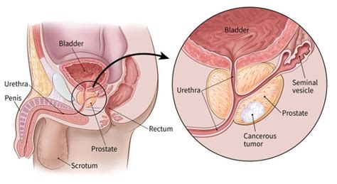 While there is not a. If You Have Prostate Cancer