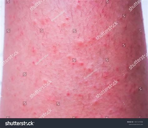 Skin Leg Itching Rashred Spots On库存照片1351147358 Shutterstock