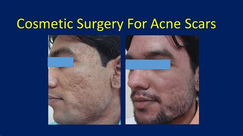 Acne Scars Cosmetic Surgery Treatmentsfractional Co2 Laser
