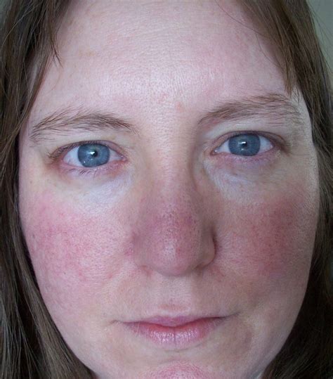 Rosacea What Is It Skin Care