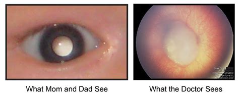 Treatment for eye cancer varies by the type and by how advanced it is. Digital Photographs Help Spot Retinoblastoma in Children ...