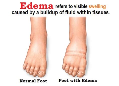 Difference Between Pitting Edema And Non Pitting Edema