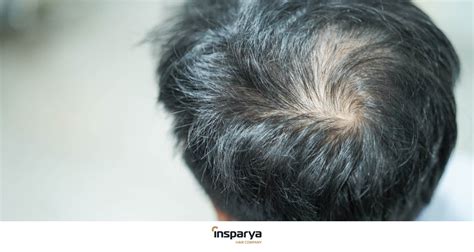 Alopecia Androgenetica Insparya