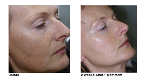 Before And After Photos Laser Aesthetic Center