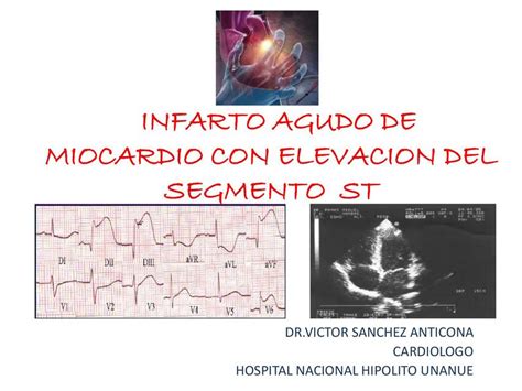 Infarto Agudo de Miocardio con Elevación del Segmento ST Ahmed Casana uDocz