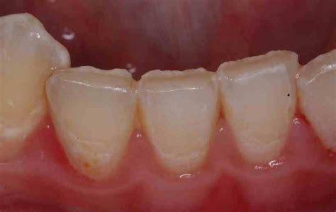 Is Tooth Wear Normal Lee Ann Brady Dmd