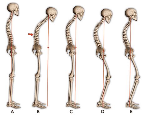 Sagittal Balance And Its Relevance In Spine Surgery Spine Surgeon