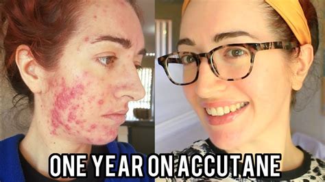 ACCUTANE Before And After Severe Acne With Pictures My Experience Jess Bunty YouTube