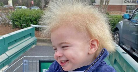 Toddler With Super Rare Uncombable Hair Syndrome Spreads Pleasure On
