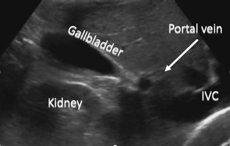 Gallbladder Ultrasound Normal Anatomy
