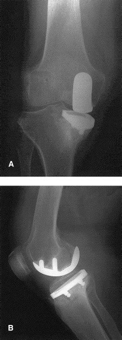 Tibial Plateau Stress Fracture The Journal Of Arthroplasty