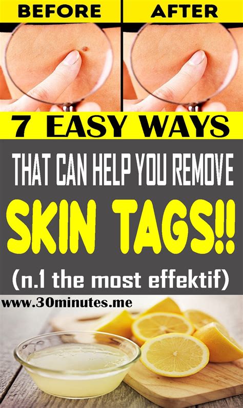 here are 7 easy ways that can help you remove skin tags health and wellness