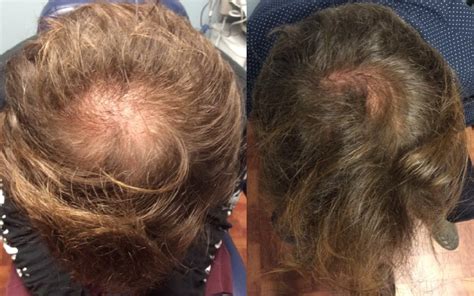 When you consider the cost. Stem Cell For Hair Loss - Dr. Ben Behnam MD, FAAD - Best ...