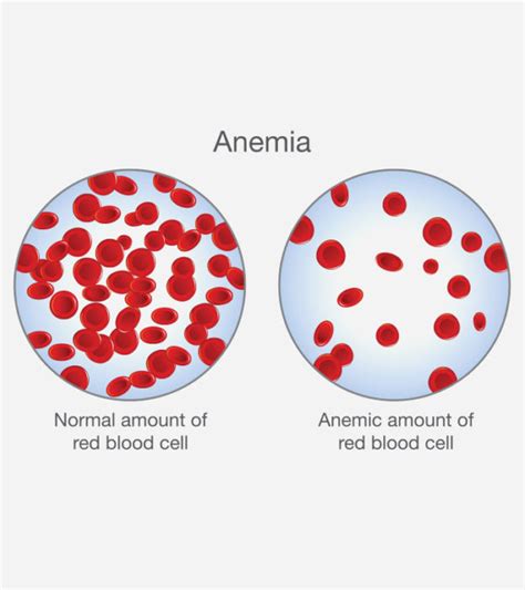 Awareness Anemia Symptoms And Its Side Efffects