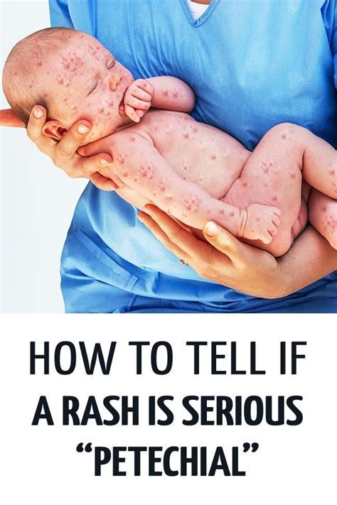 How To Tell If A Rash In A Child Is The Serious Petechial Rash That Can