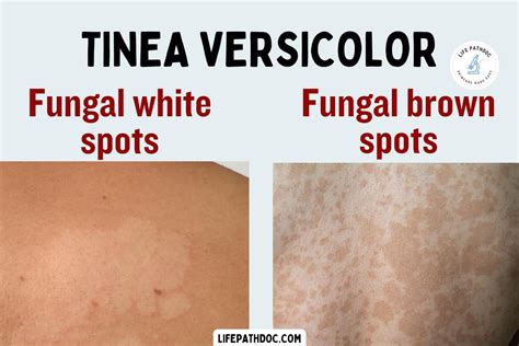 Tinea Versicolor Brown Spots Or White Patch On Skin By Fungus