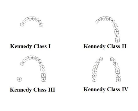 Kennedy Classification Is A Categorization Of Edentulism Divided Into