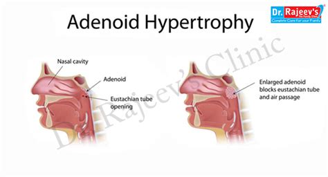 Adenoid Hypertrophy In Adults