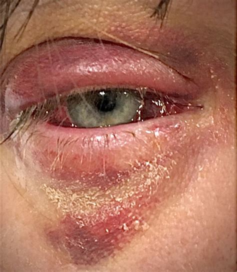 Upper And Lower Right Eyelid Showing Redness Ecchymoses Swelling