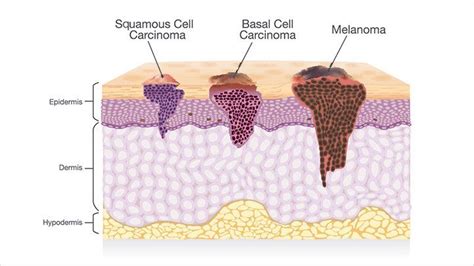 Skin Cancer Types And Their Features Everyday Health