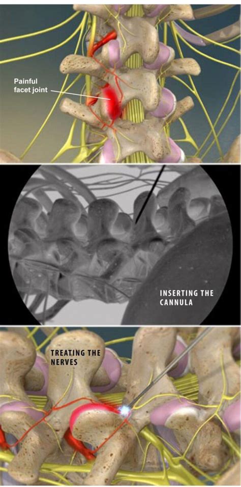Radiofrequency Neurotomy Of The Lumbar Facets Stephen P Courtney Md Orthopedic Spine