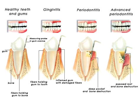 Mouth Body Connection Of Periodontal Disease Auburn Dental Center Bakersfield Ca