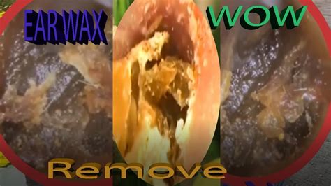 Huge Tonsil Stones Ear Wax Removal In A Case Of Chronic Tonsillitis