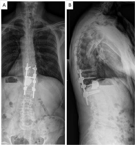 Anteroposterior Fig 4 A And Lateral Fig 4 B Postoperative