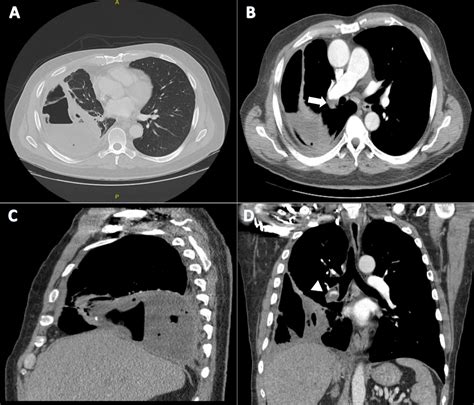 Computed Tomography Of Chest In Coronal Axial And Sagital Images My