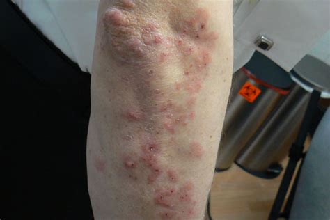 Pruritic Rash Develops After A Change In Diet Clinical