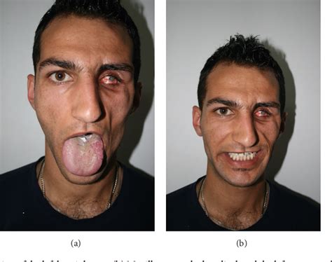severe parry romberg syndrome