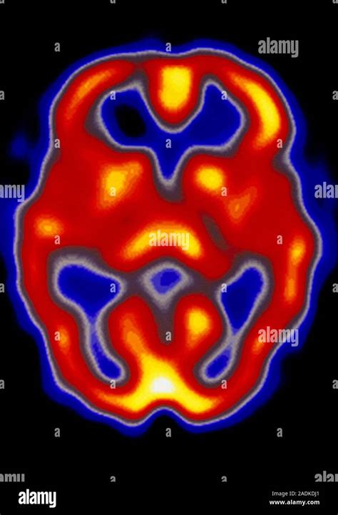 Healthy Brain Coloured Single Photon Emission Computed Tomography