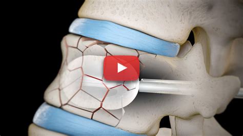 Kyphoplasty Interventional Spine Pain Management Encinitas CA