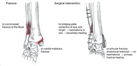 In A Comminuted Fracture Of The Fibula And A Medial Malleolus Avulsion