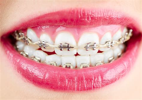 Orthodontics Metal Braces S Dental Clinic
