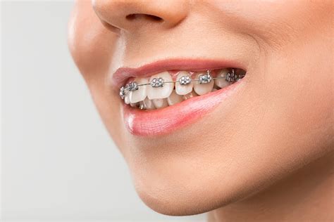 The Average Cost Of Braces Vs Invisalign The Orthodontic Place