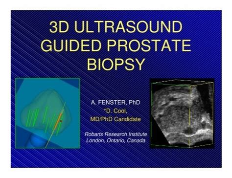 3d Ultrasound Guided Prostate Biopsy