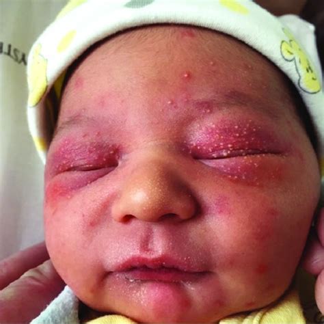 Download Pdf Newborn With Bilateral Eyelid Swelling Rash And Erythema