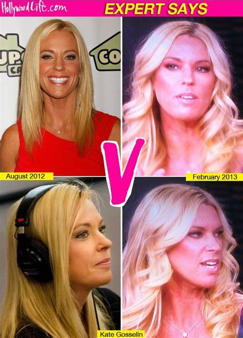 Kate Gosselin Plastic Surgery Before And After Nose Job Facelift Pictures