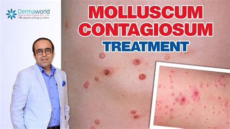 Molluscum Contagiosum Pictures Symptoms Treatment My Xxx Hot Girl