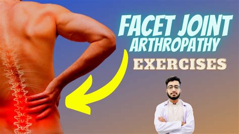 Facet Joint Arthropathy Exercises Treatment Physiotherapy L4 L5 L5 S1